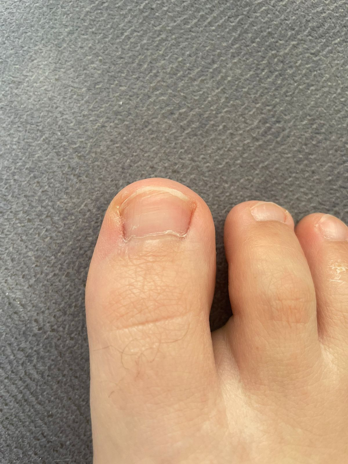 Онихомикоз - грибок ногтя. Подолог г. Хабаровск — центр здоровой стопы «FOOTTIME»