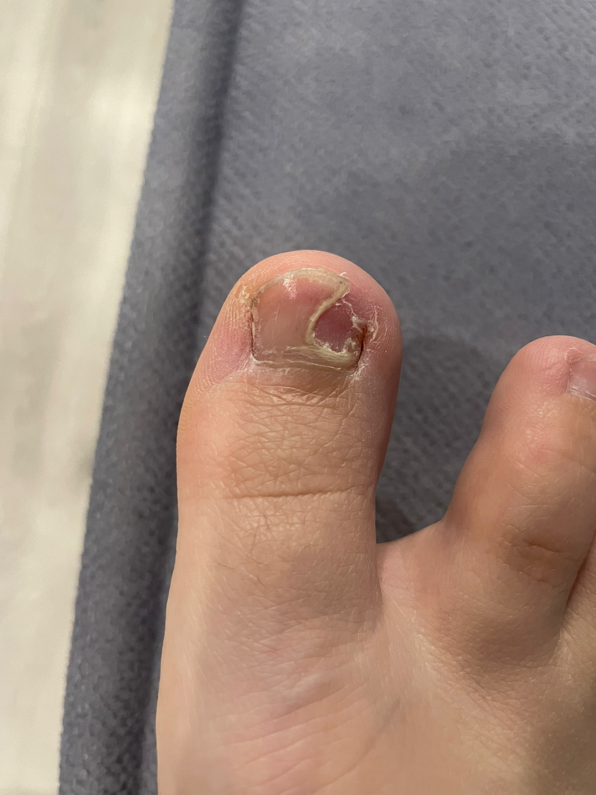 Онихомикоз - грибок ногтя. Подолог г. Хабаровск — центр здоровой стопы «FOOTTIME»