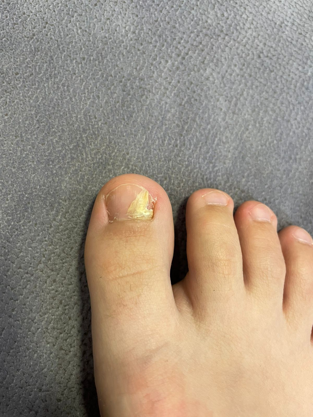 Онихомикоз - грибок ногтя. Подолог г. Хабаровск — центр здоровой стопы «FOOTTIME»