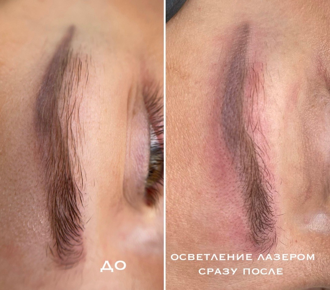 УДАЛЕНИЕ СТАРОГО ТАТУАЖА. Перманентный макияж и удаление старого татуажа в Ростове-на-Дону Дарья Исакова