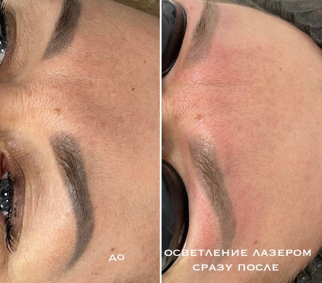 УДАЛЕНИЕ СТАРОГО ТАТУАЖА. Перманентный макияж и удаление старого татуажа в Ростове-на-Дону Дарья Исакова