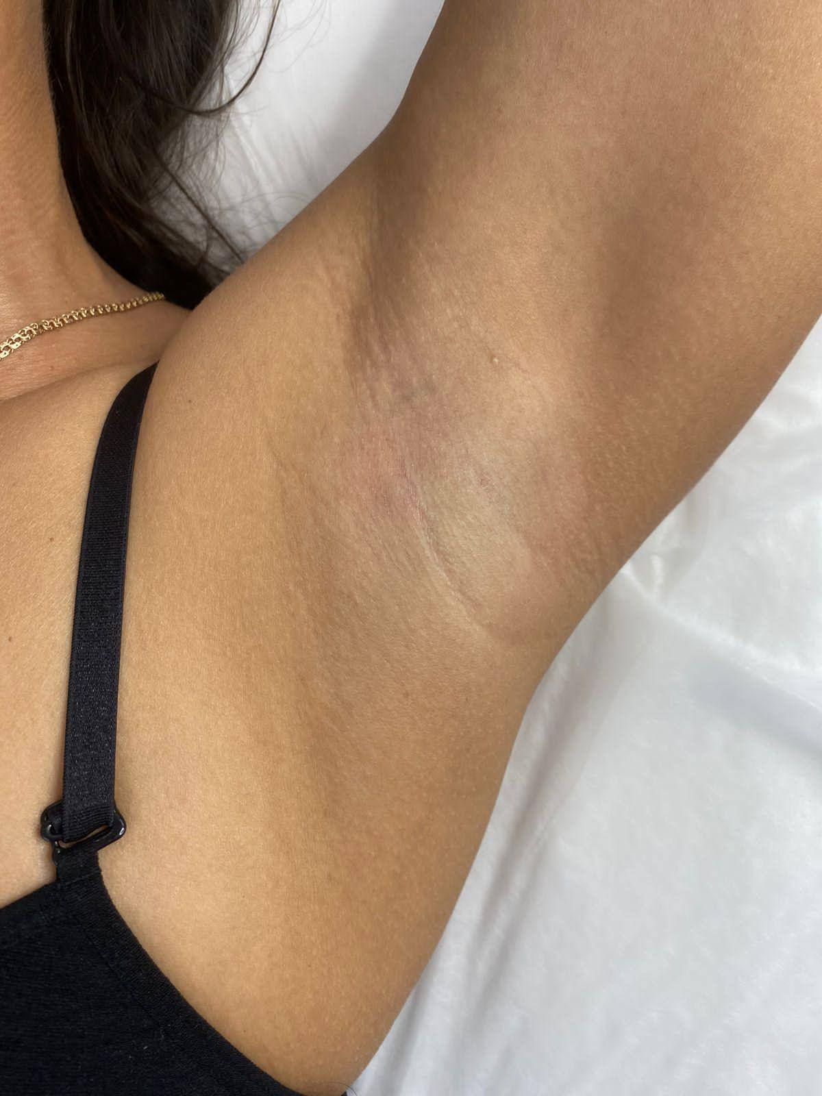 Лазерная эпиляция в г. Кемерово, г. Новокузнецке и г. Киселевске