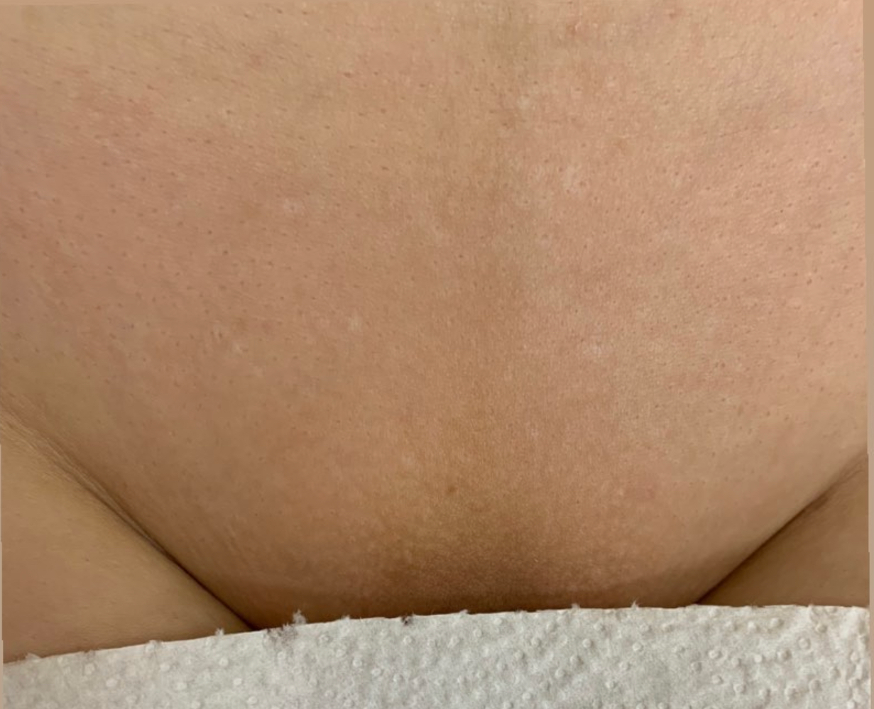 Лазерная эпиляция в г. Кемерово, г. Новокузнецке и г. Киселевске