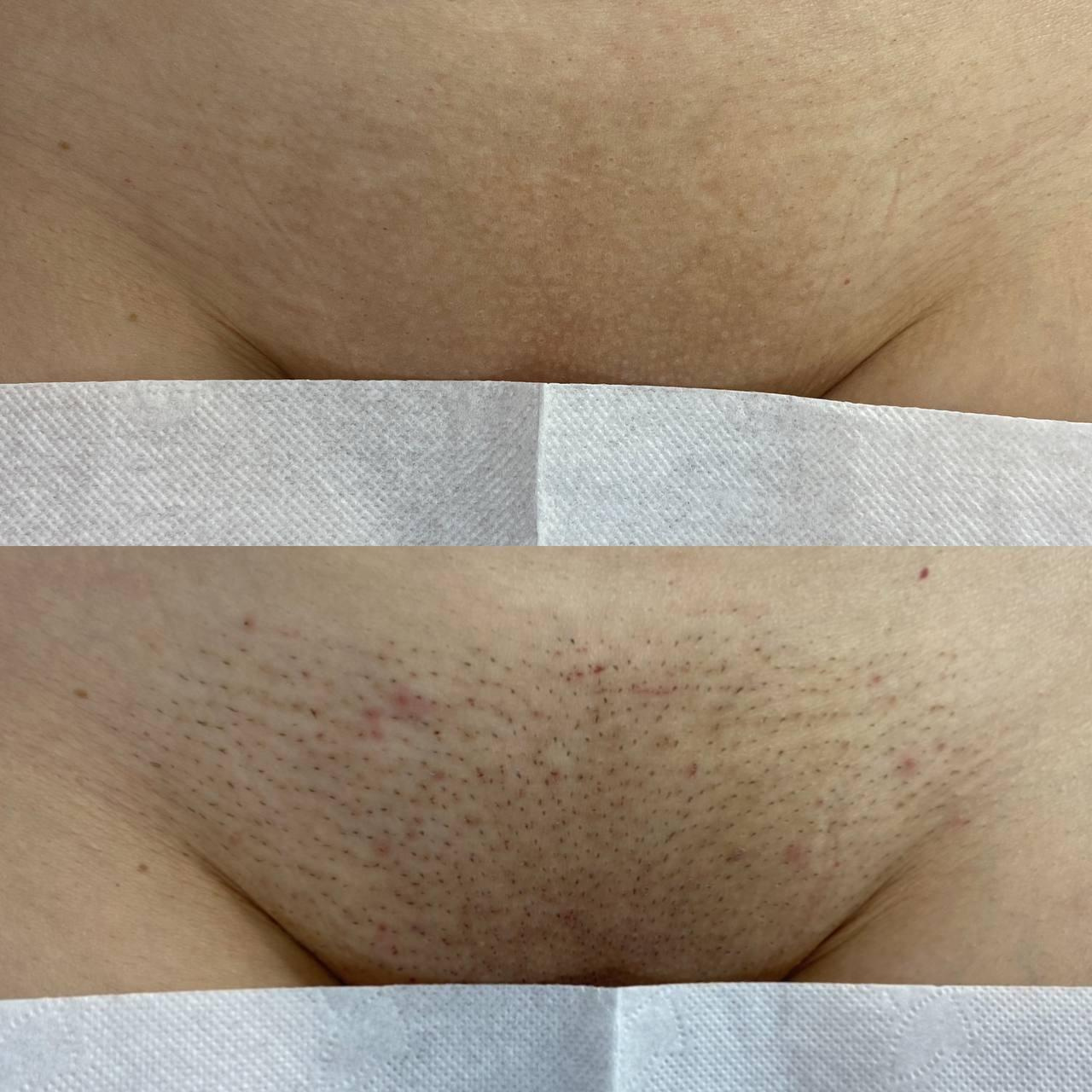 Лазерная эпиляция в г. Кемерово, г. Новокузнецке и г. Киселевске