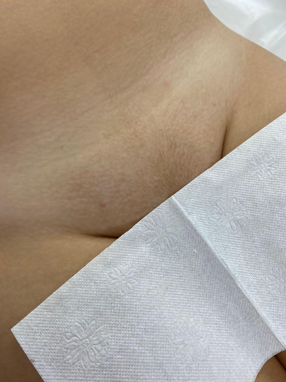 Лазерная эпиляция в г. Кемерово, г. Новокузнецке и г. Киселевске