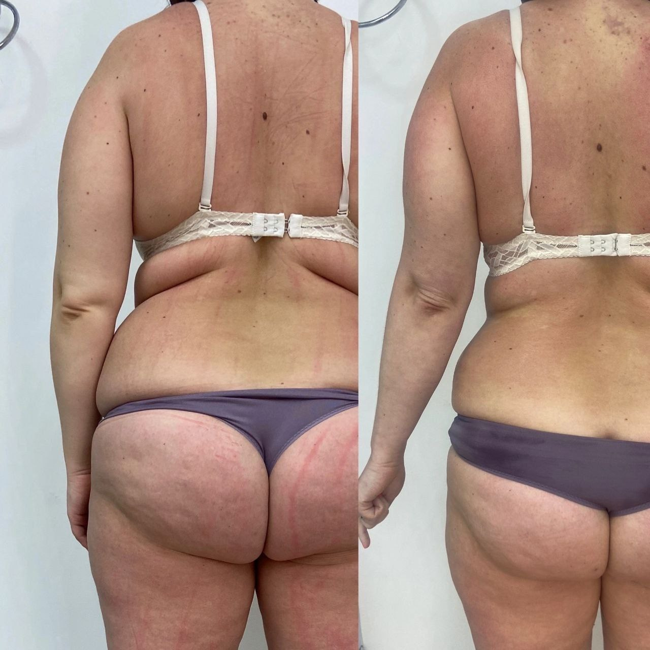 Результаты. Центр Коррекции Тела в городе Чехов