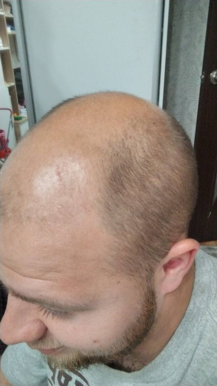 Нажмите на фото что бы открыть. SMP Трихопигментация Воронеж Волгоград Москва Казань Никита Нестеров