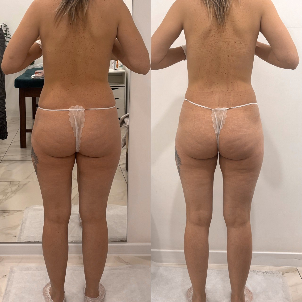 Аппаратный массаж BBEndospheres