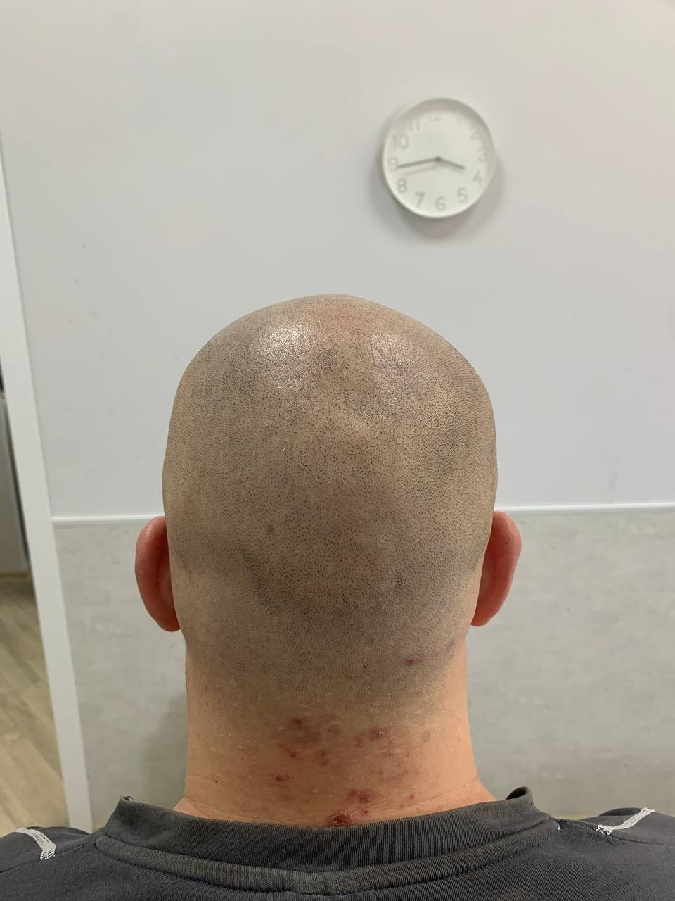 Нажмите на фото что бы открыть. SMP Трихопигментация Воронеж Волгоград Москва Казань Никита Нестеров