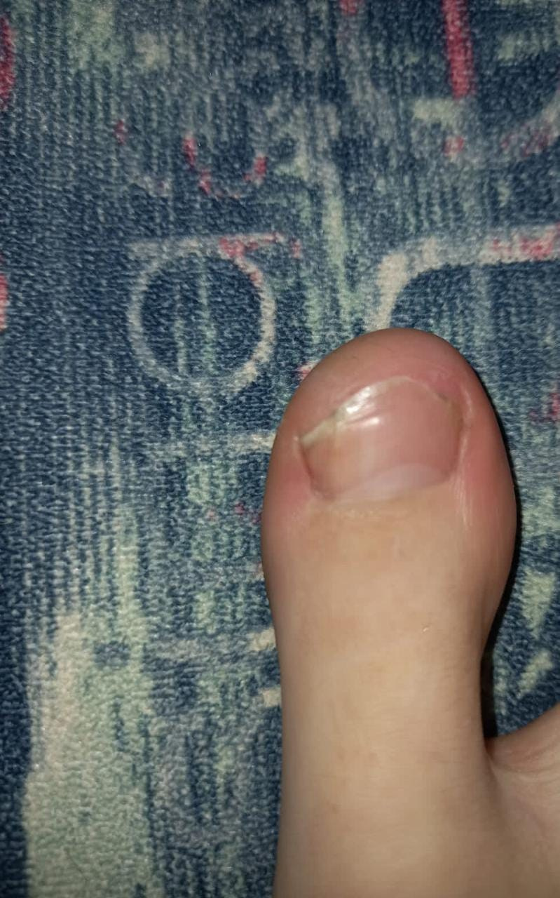 Экзостоз у девочки 13 лет. Подолог г. Хабаровск — центр здоровой стопы «FOOTTIME»