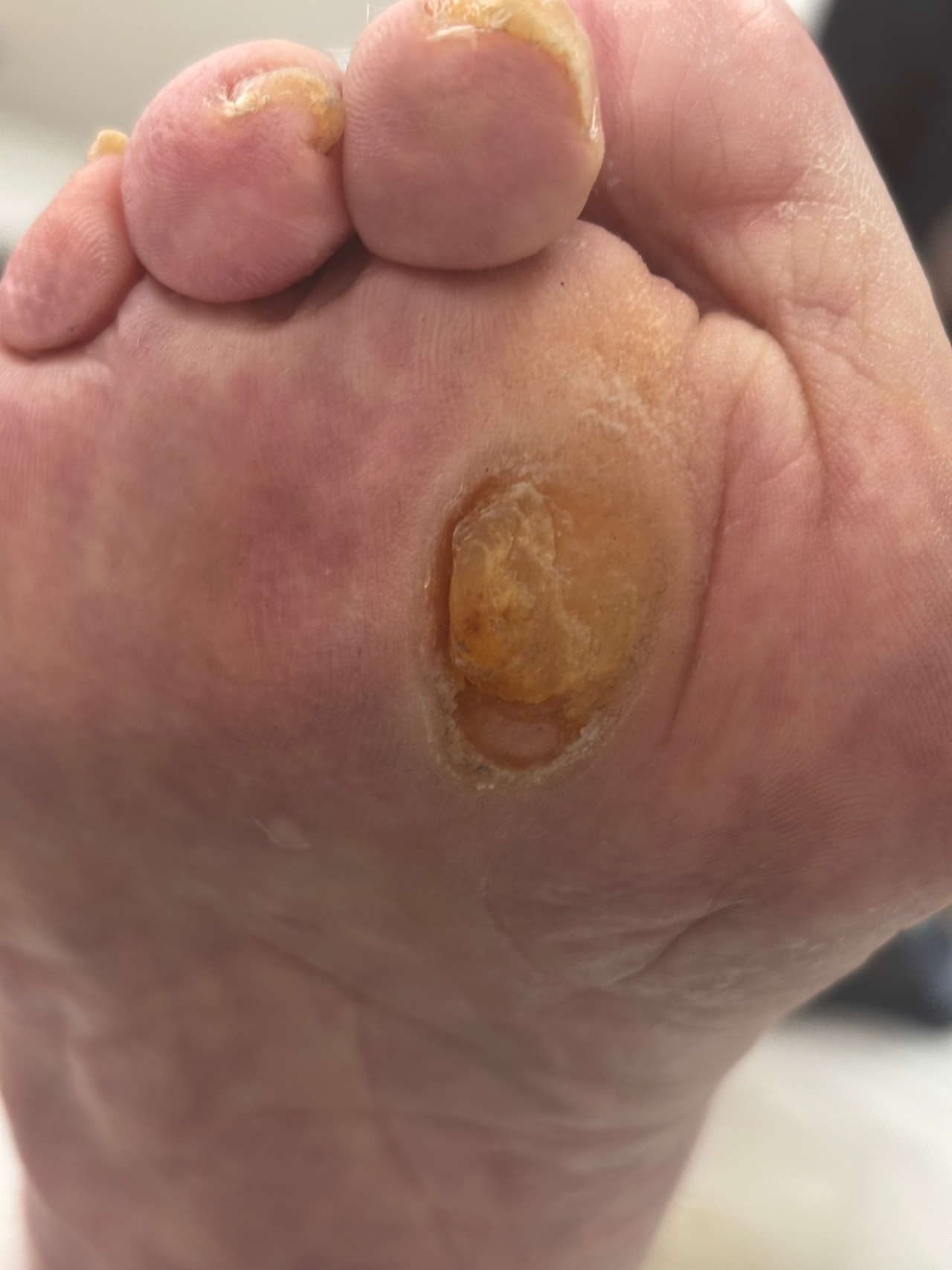 Обработка натоптыша. Подолог г. Хабаровск — центр здоровой стопы «FOOTTIME»