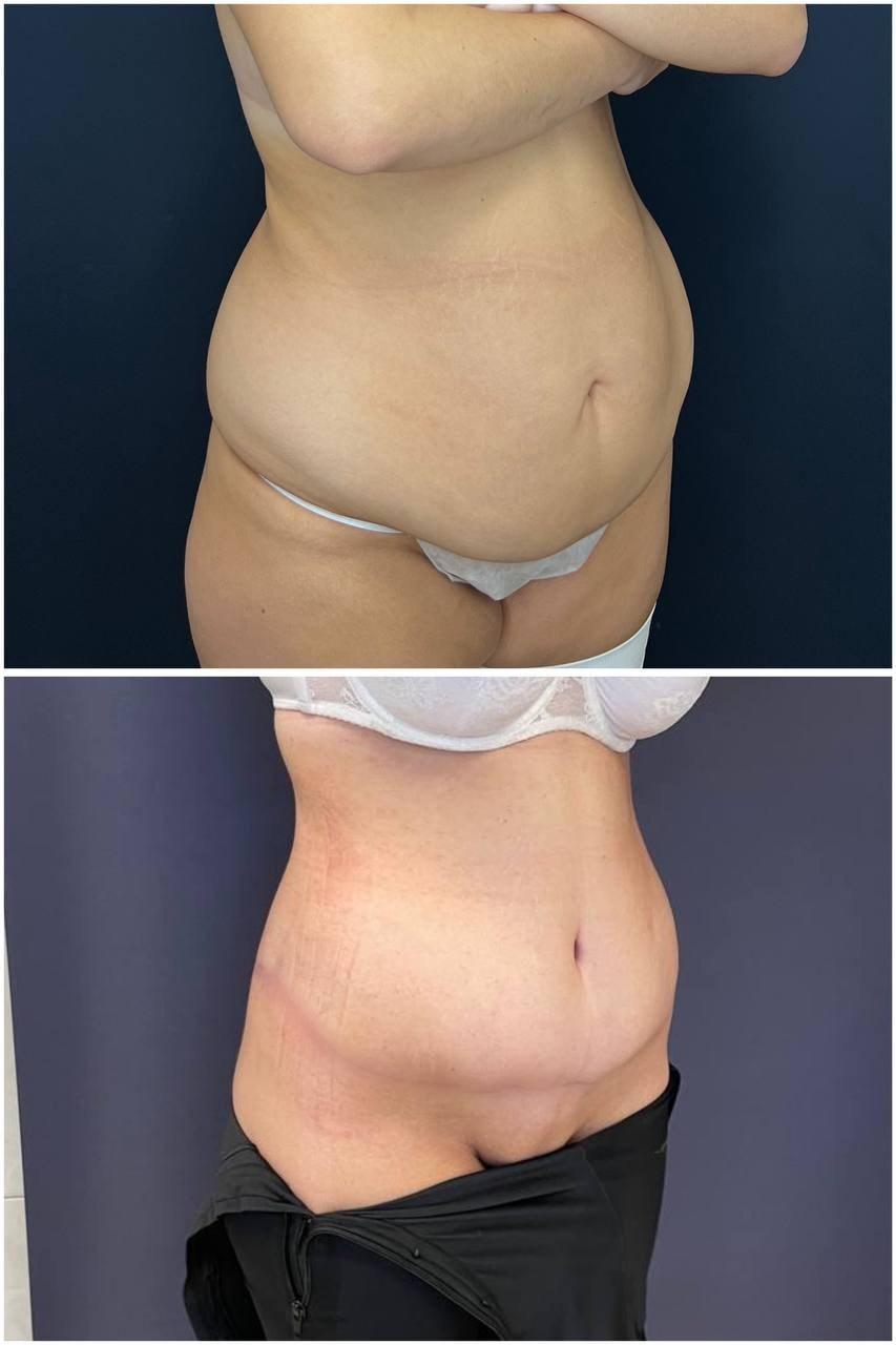 Всех приветствую! Результат нижнего бодилифтинга через 2 месяца после операции. Горбачевская Ксения Андреевна — пластический хирург