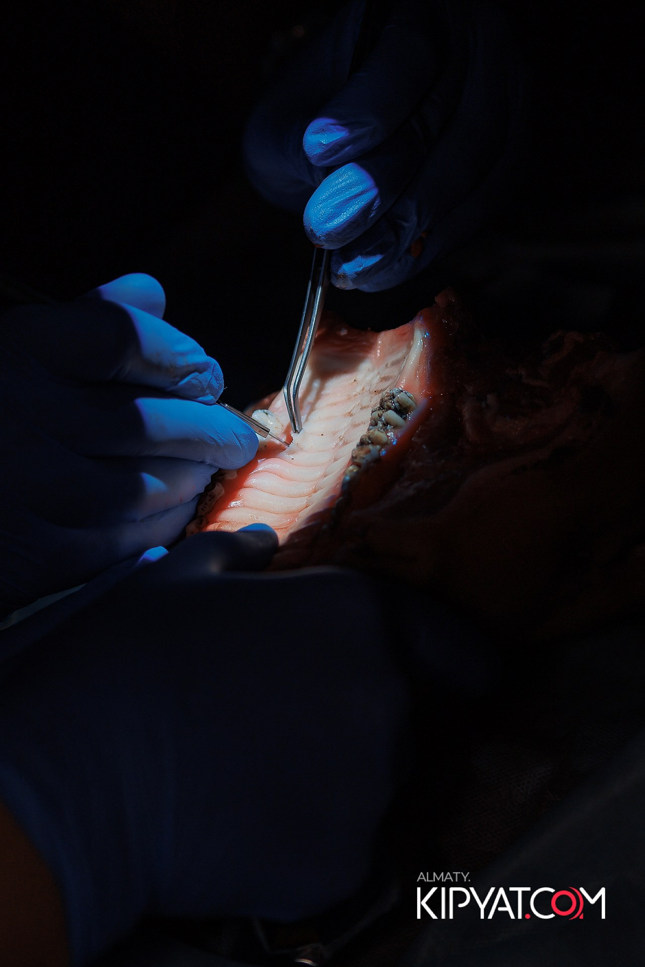 КУРС СТОМАТОЛОГОВ «НКР И ПОСЛЕДУЮЩАЯ РАБОТА С МЯГКИМИ ТКАНЯМИ». КИПЯТКОМ АЛМАТЫ!