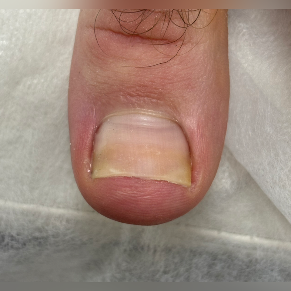 Решение проблемы вросшего ногтя. Подолог г. Хабаровск — центр здоровой стопы «FOOTTIME»