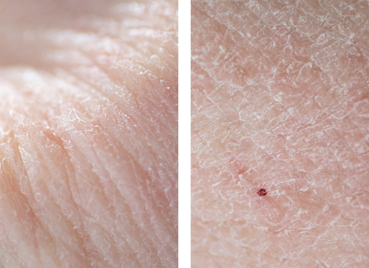 — Epidermics. Lena Ovchinnikova