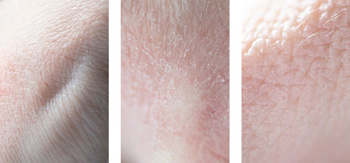 — Epidermics. Lena Ovchinnikova