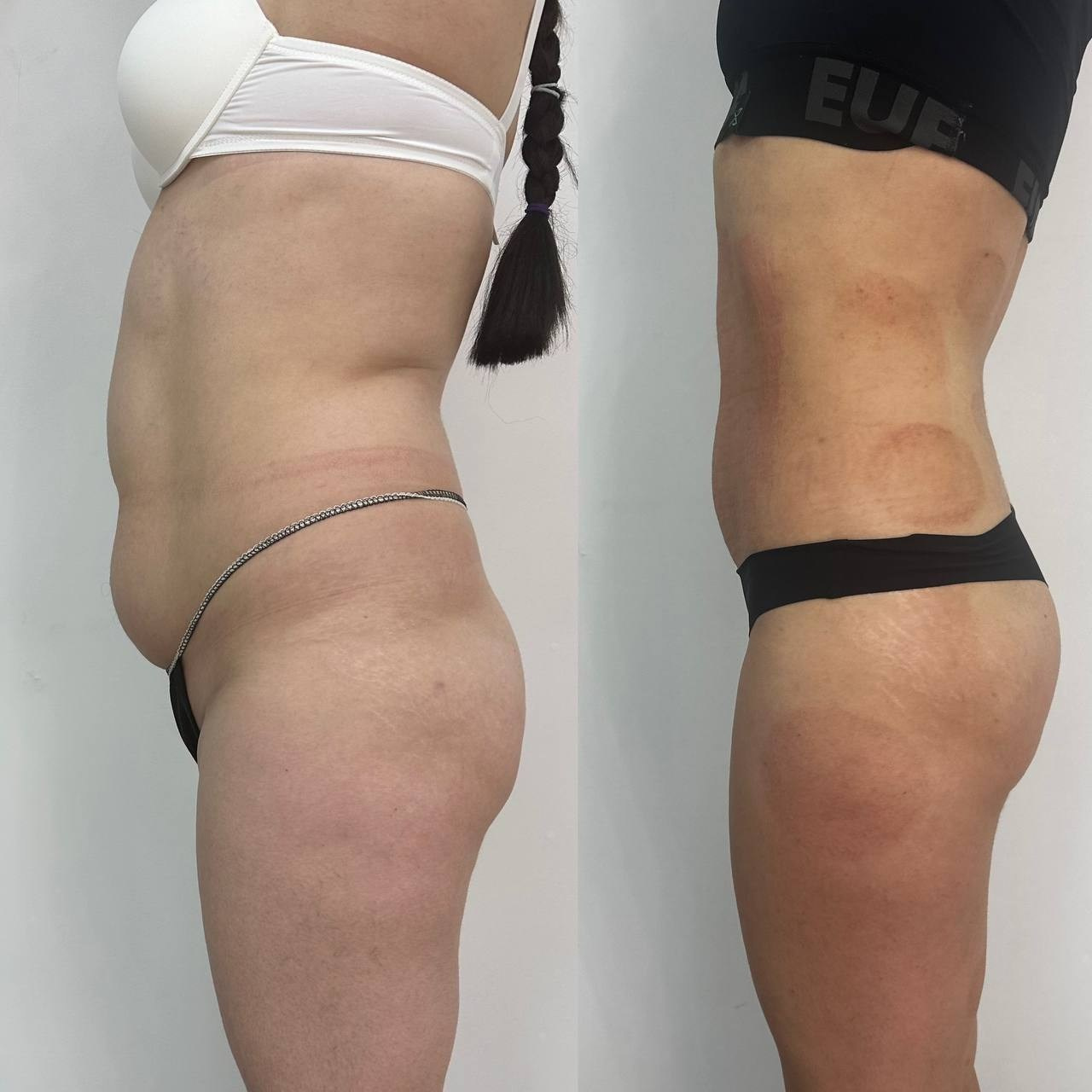 Результаты. Центр Коррекции Тела в городе Чехов