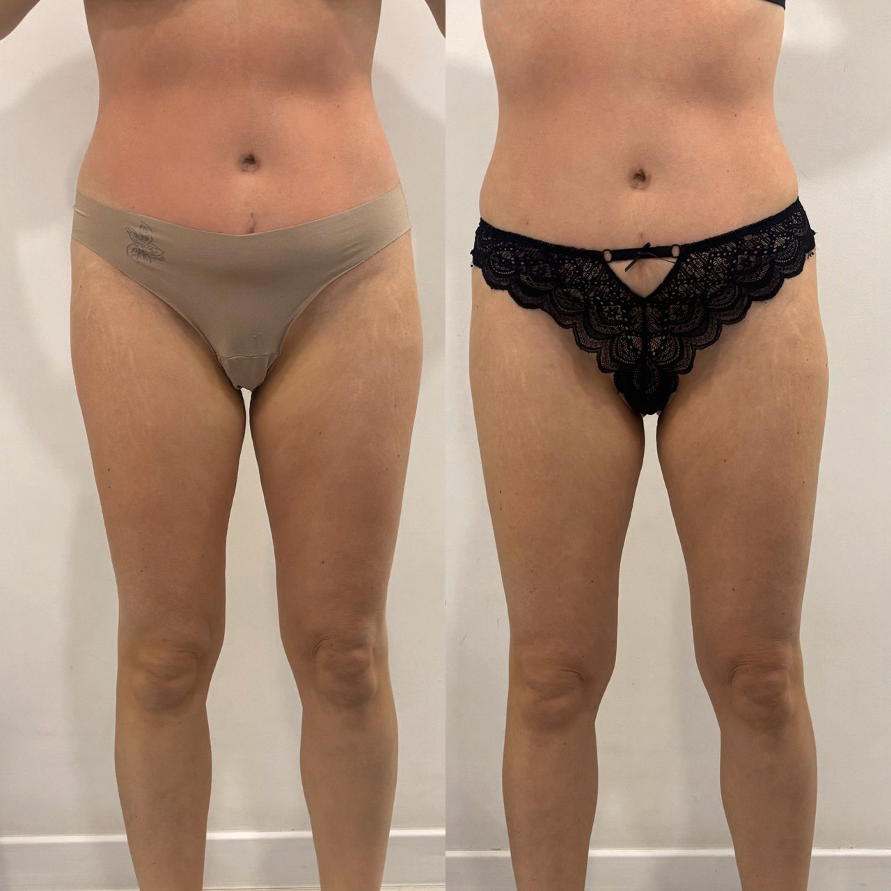 Аппаратный массаж, эндосфера, ручной массаж. Студия перманентного макияжа, косметологии и массажа SYMMETRY в Москве, м. Киевская