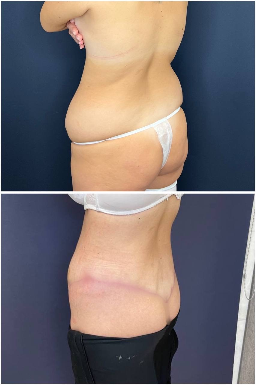 Всех приветствую! Результат нижнего бодилифтинга через 2 месяца после операции. Горбачевская Ксения Андреевна — пластический хирург
