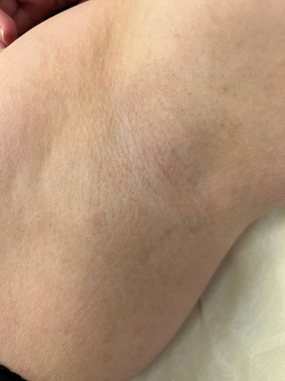 Наши результаты. Лазерная эпиляция в г. Кемерово, г. Новокузнецке и г. Киселевске