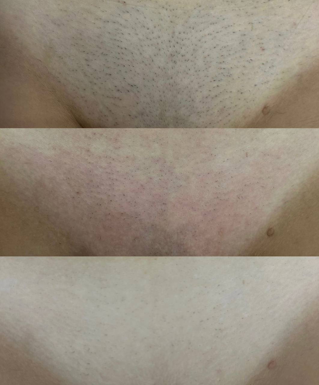 Лазерная эпиляция в г. Кемерово, г. Новокузнецке и г. Киселевске