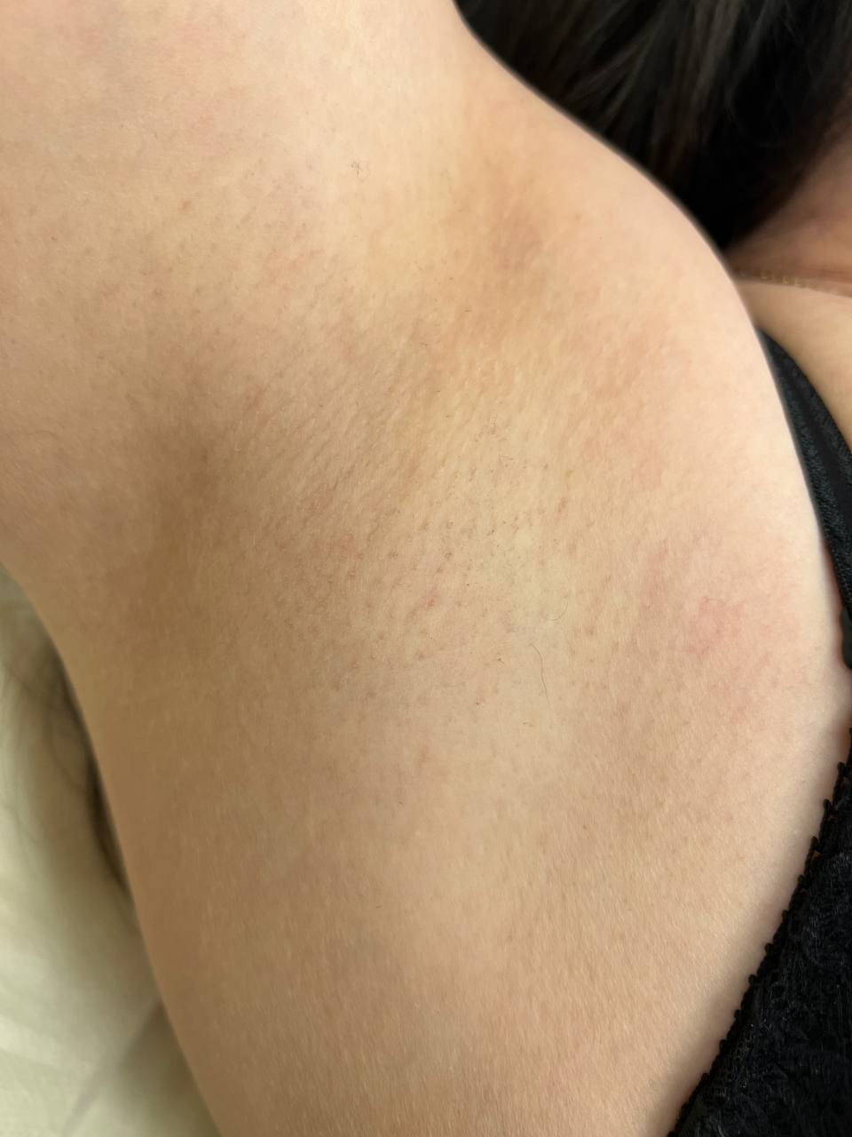 Лазерная эпиляция в г. Кемерово, г. Новокузнецке и г. Киселевске