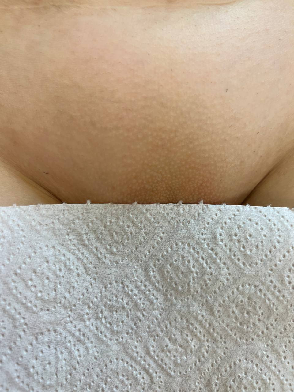 Лазерная эпиляция в г. Кемерово, г. Новокузнецке и г. Киселевске