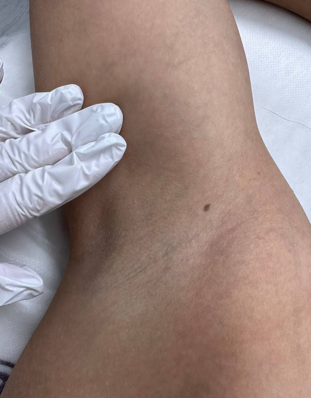 Лазерная эпиляция в г. Кемерово, г. Новокузнецке и г. Киселевске