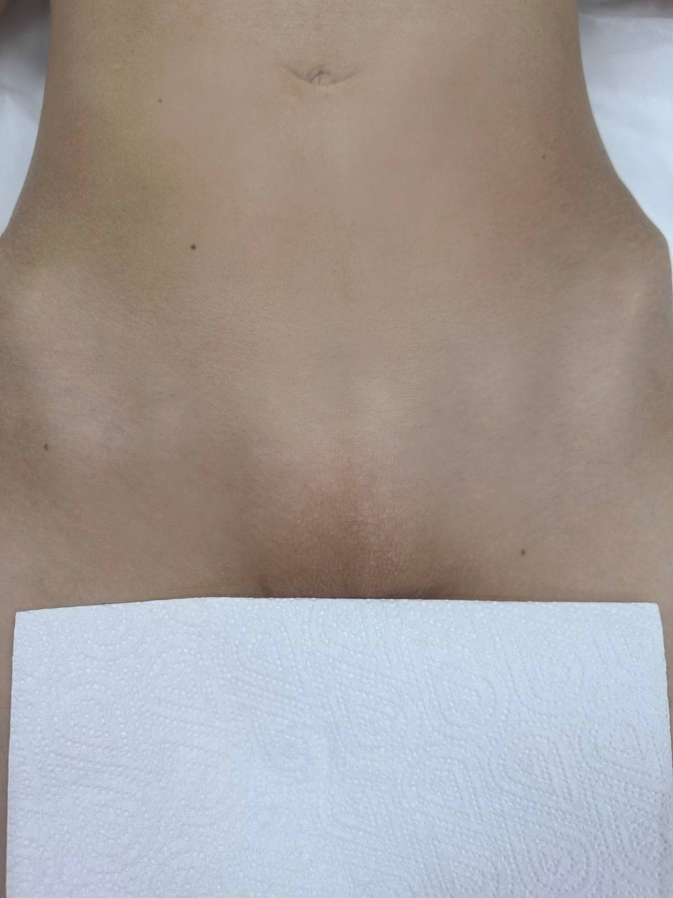 Лазерная эпиляция в г. Кемерово, г. Новокузнецке и г. Киселевске