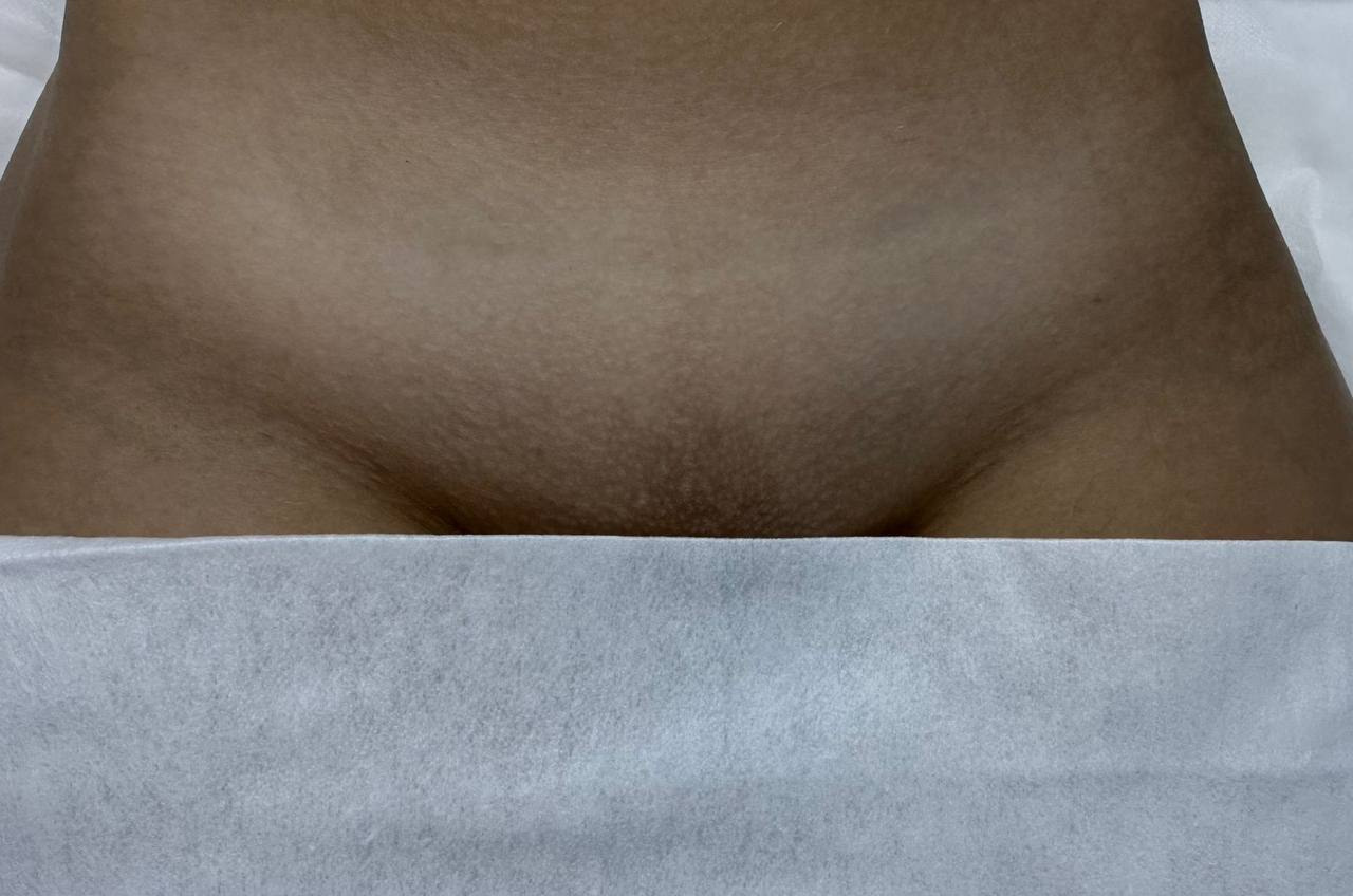 Лазерная эпиляция в г. Кемерово, г. Новокузнецке и г. Киселевске