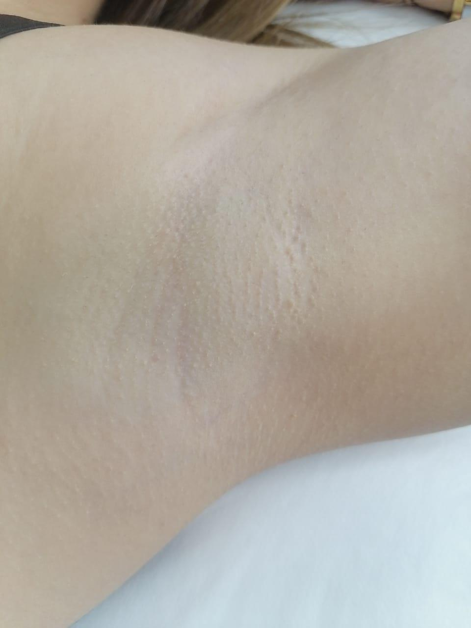 Наши результаты. Лазерная эпиляция в г. Кемерово, г. Новокузнецке и г. Киселевске