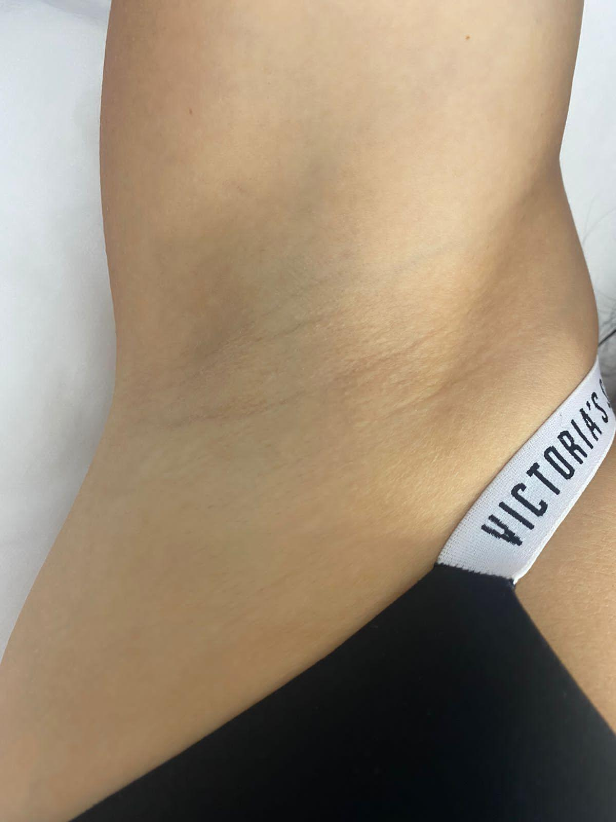 Наши результаты. Лазерная эпиляция в г. Кемерово, г. Новокузнецке и г. Киселевске