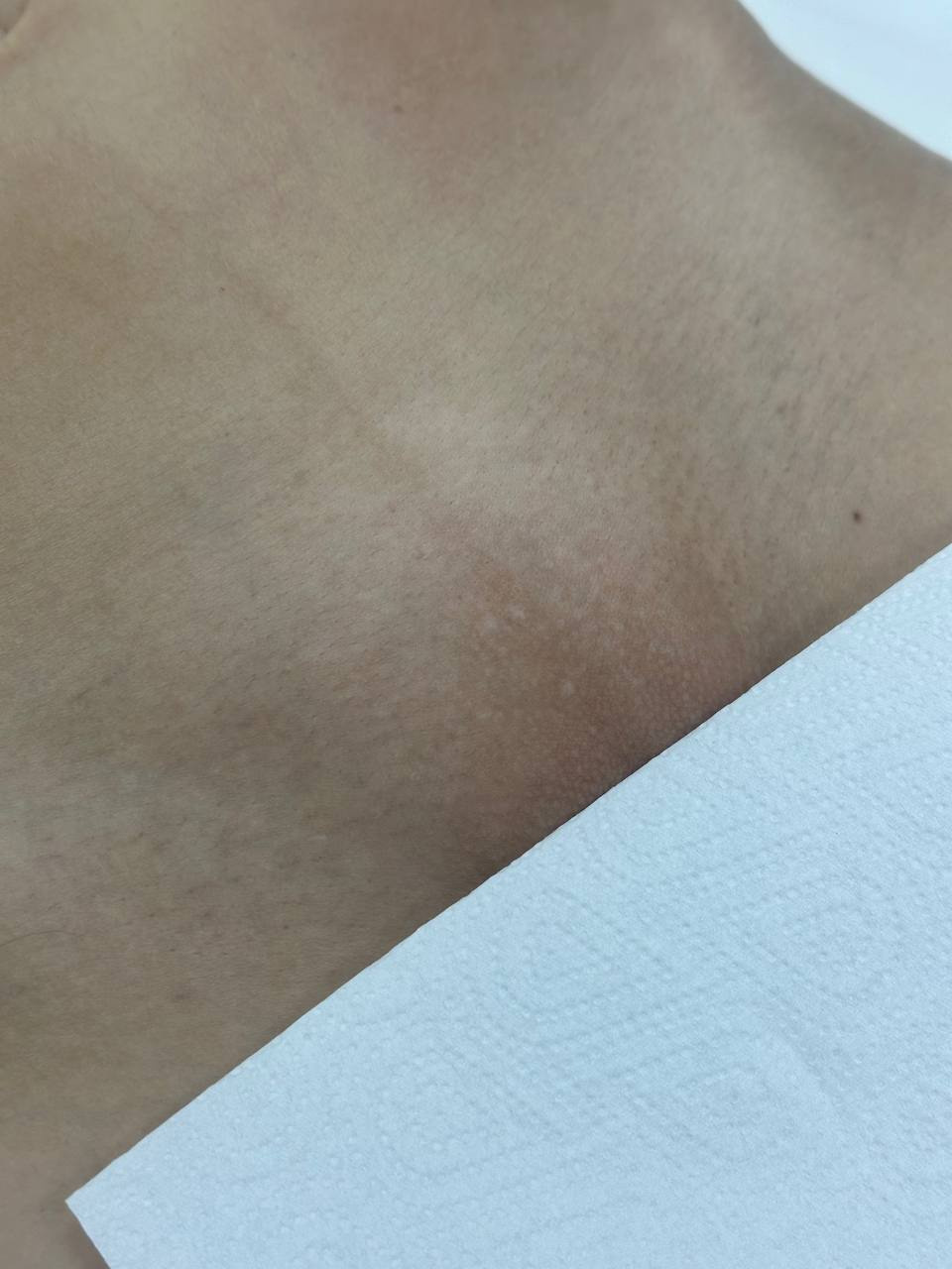 Лазерная эпиляция в г. Кемерово, г. Новокузнецке и г. Киселевске