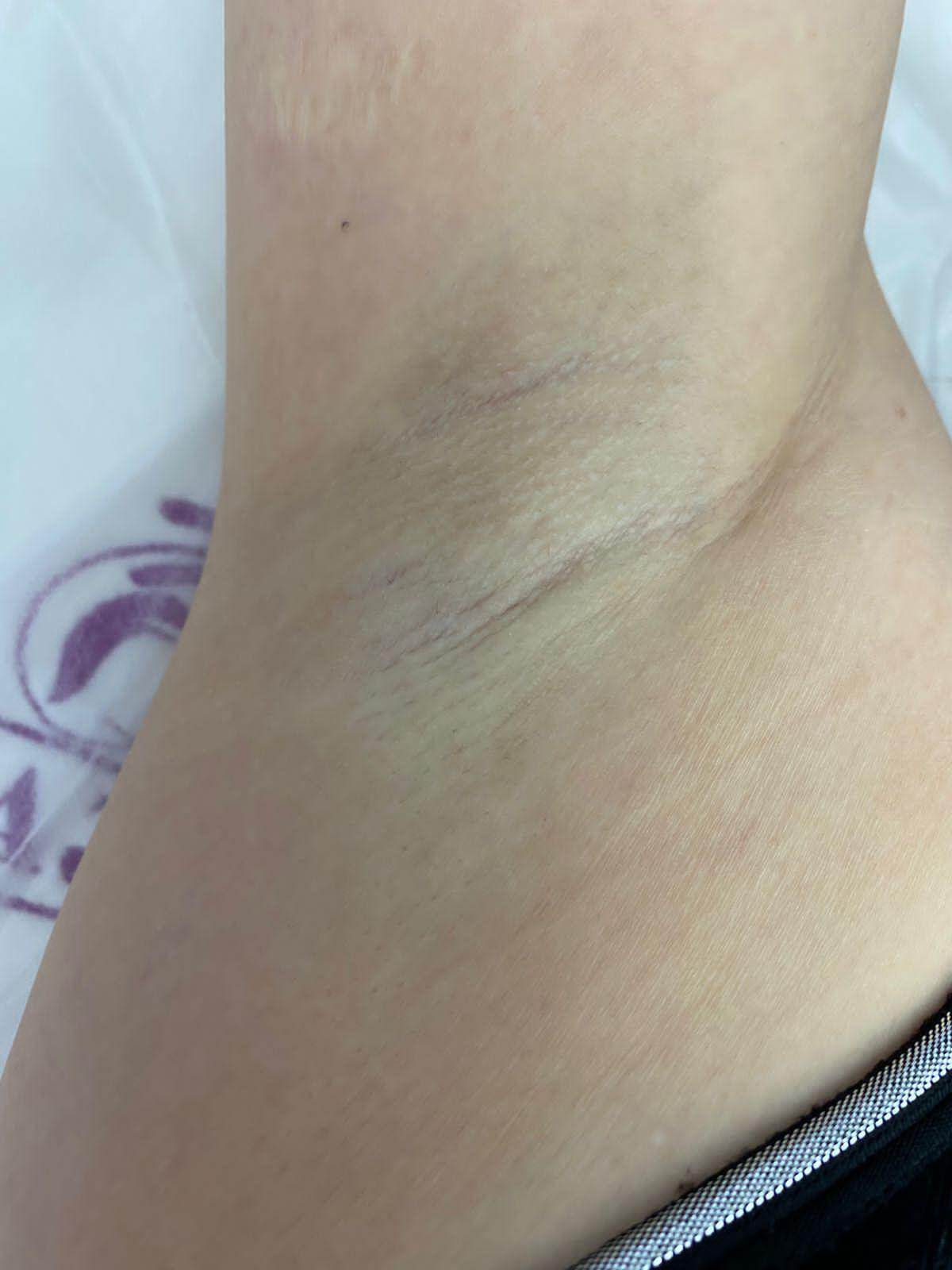 Наши результаты. Лазерная эпиляция в г. Кемерово, г. Новокузнецке и г. Киселевске