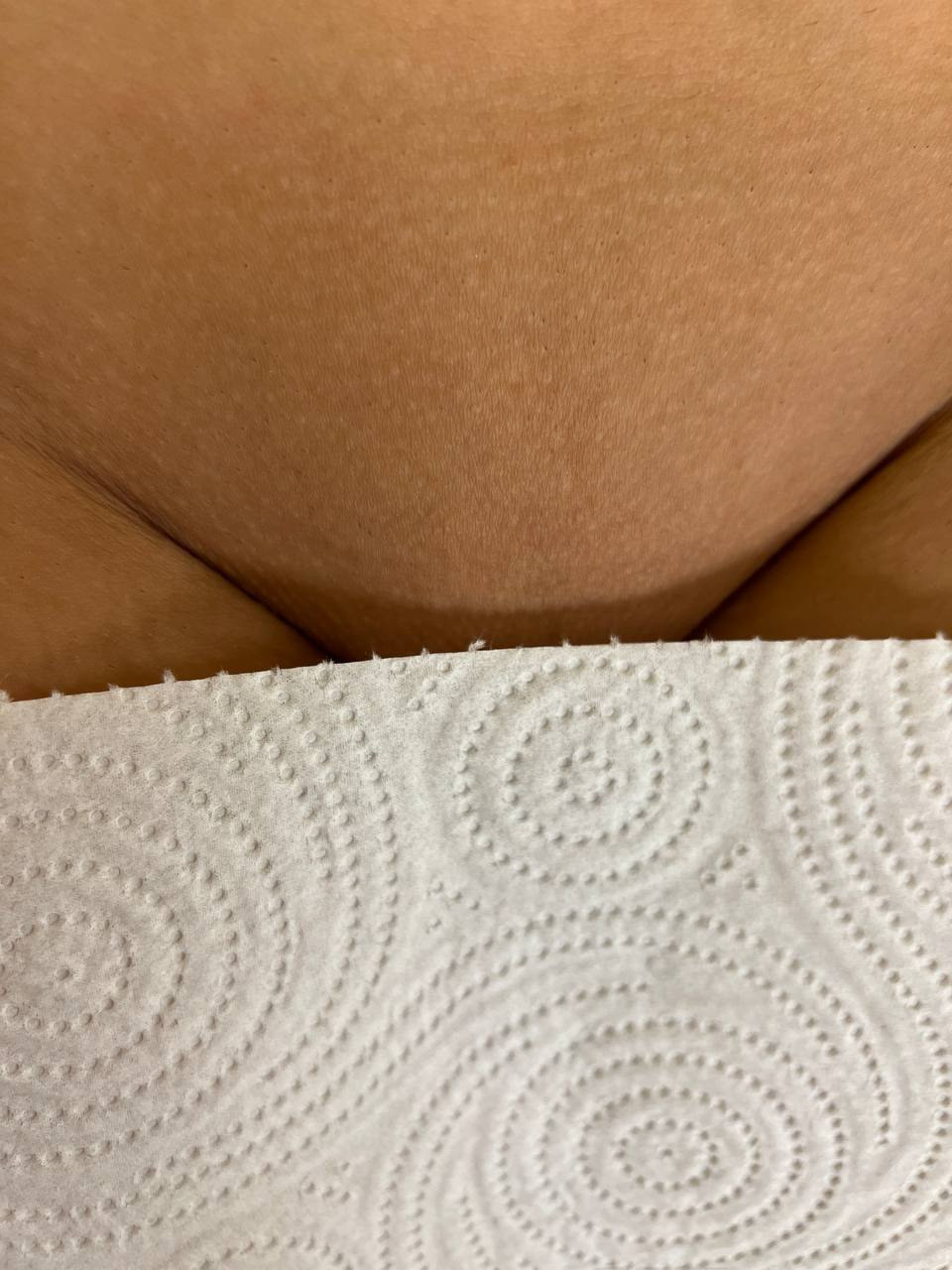 Наши результаты. Лазерная эпиляция в г. Кемерово, г. Новокузнецке и г. Киселевске