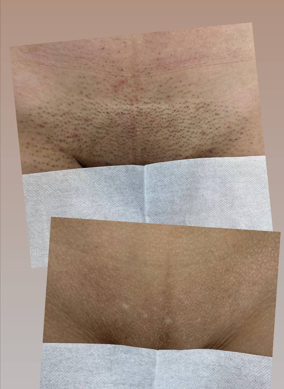 Наши результаты. Лазерная эпиляция в г. Кемерово, г. Новокузнецке и г. Киселевске