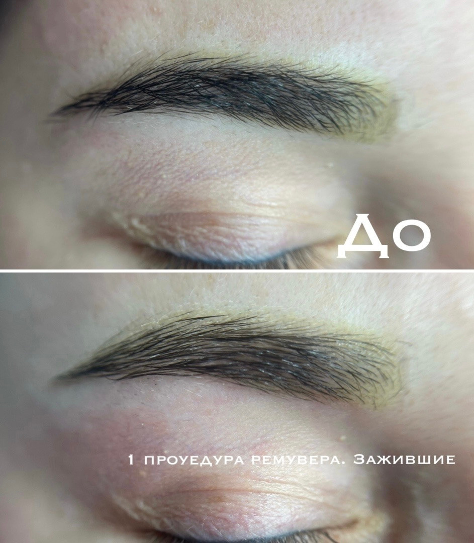 УДАЛЕНИЕ СТАРОГО ТАТУАЖА. Перманентный макияж и удаление старого татуажа в Ростове-на-Дону Дарья Исакова