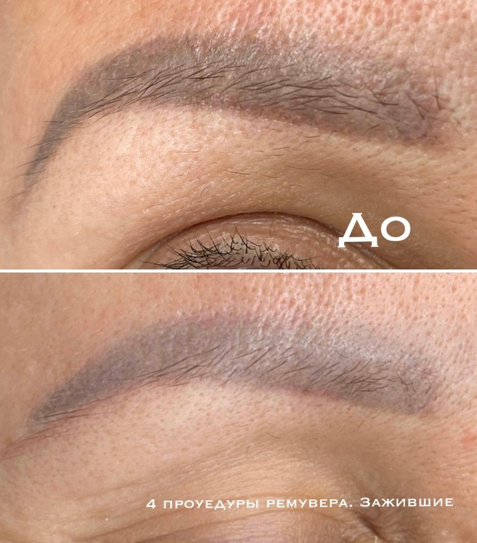 лазерное удаление татуажа в Ростов-на-Дону