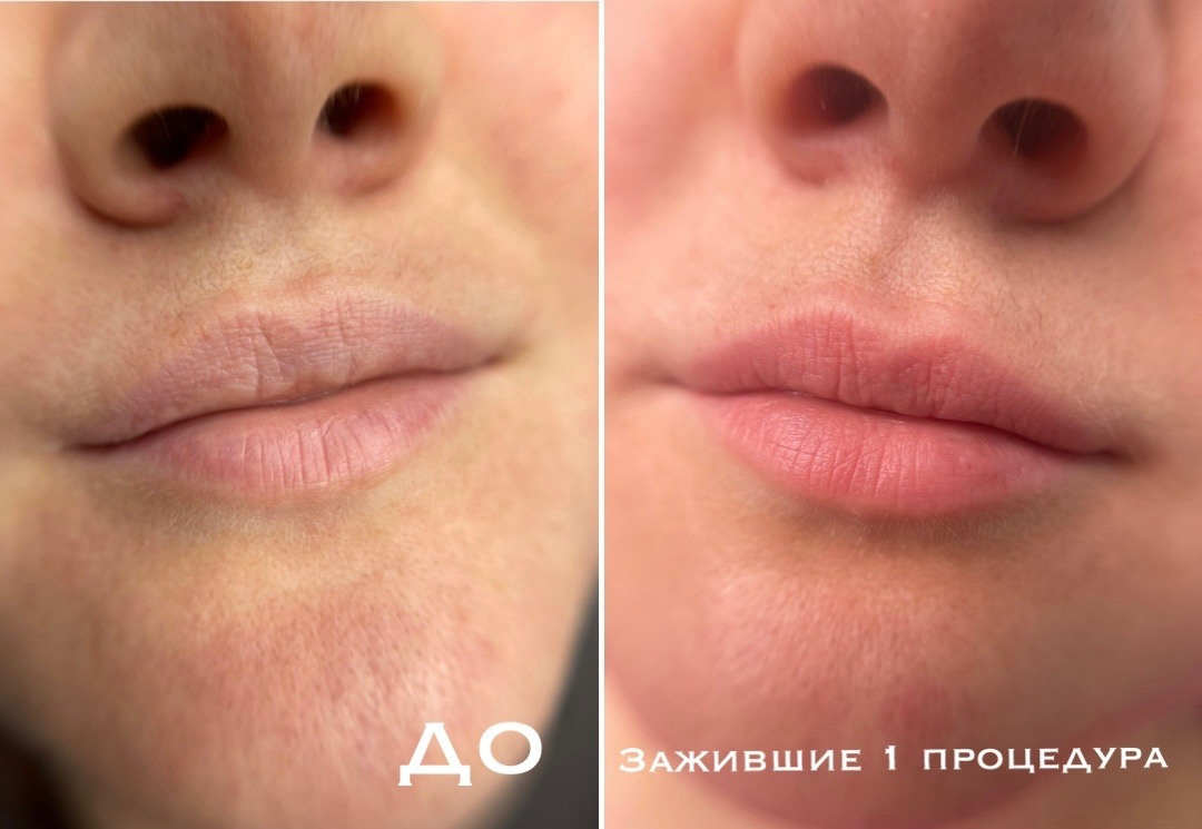 заживший перманентный макияж губ после первичной процедуры