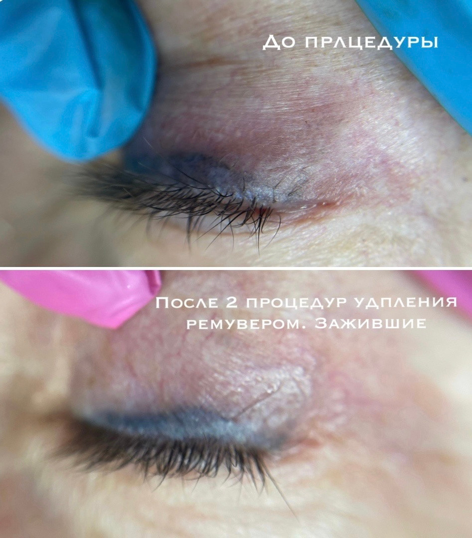 УДАЛЕНИЕ СТАРОГО ТАТУАЖА. Перманентный макияж и удаление старого татуажа в Ростове-на-Дону Дарья Исакова