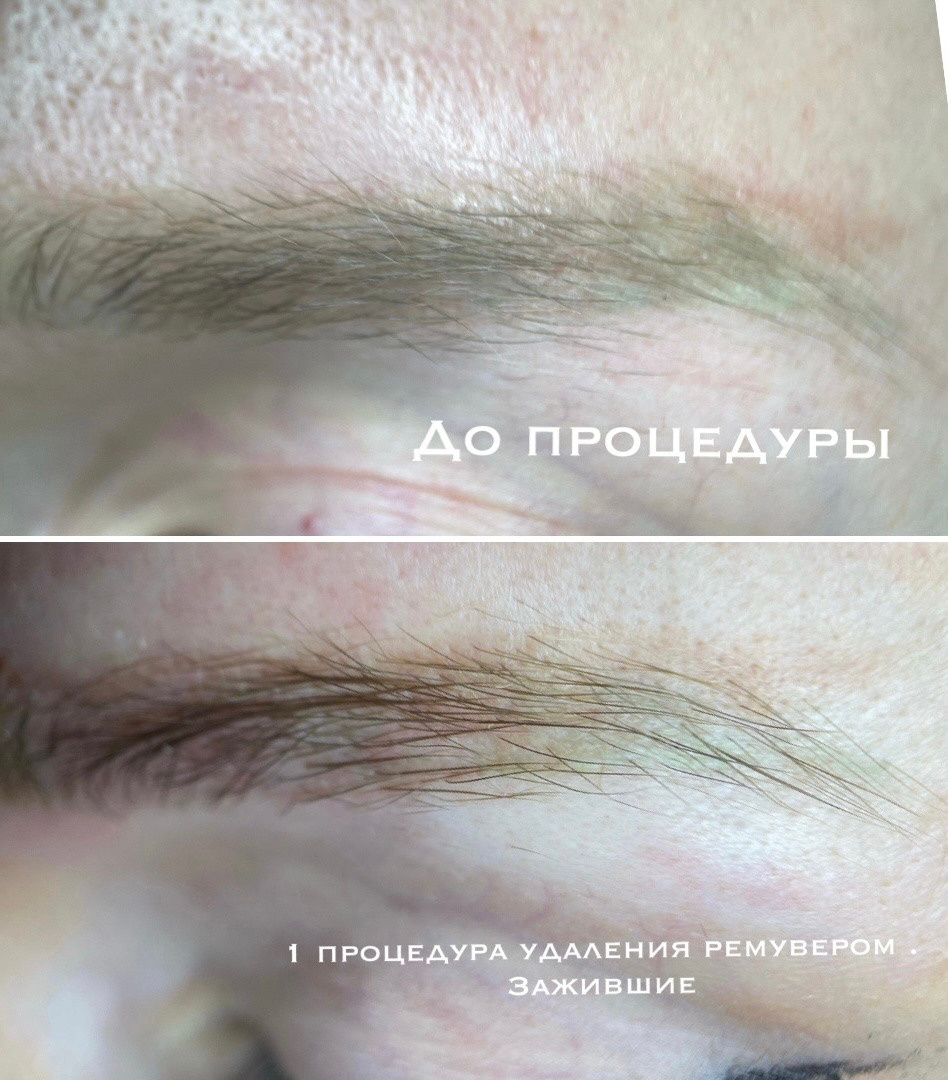 УДАЛЕНИЕ СТАРОГО ТАТУАЖА. Перманентный макияж и удаление старого татуажа в Ростове-на-Дону Дарья Исакова
