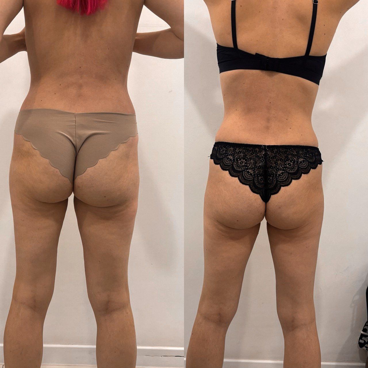 Аппаратный массаж, эндосфера, ручной массаж. Студия перманентного макияжа, косметологии и массажа SYMMETRY в Москве, м. Киевская