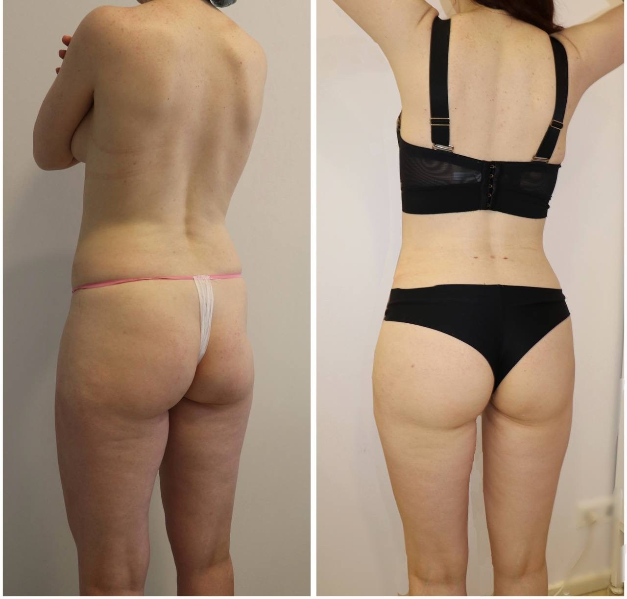 Результат липоскульптурирования и липомоделирования. Горбачевская Ксения Андреевна — пластический хирург