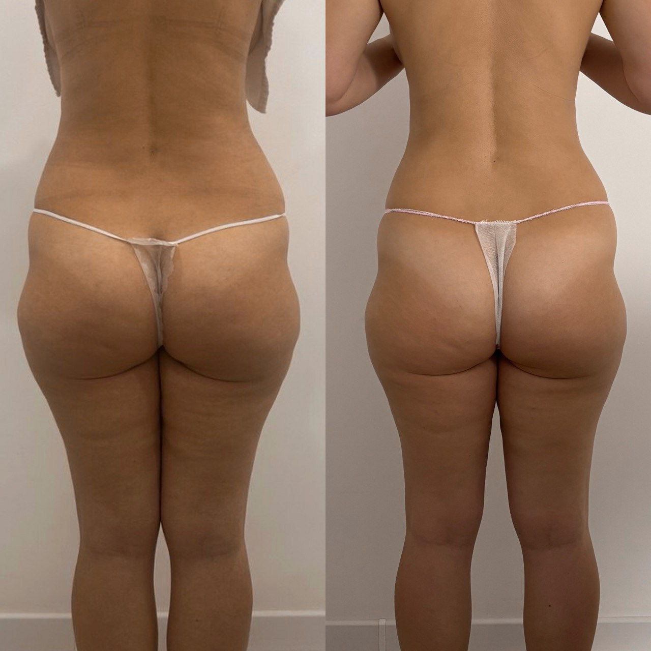 Аппаратный массаж, эндосфера, ручной массаж. Студия перманентного макияжа, косметологии и массажа SYMMETRY в Москве, м. Киевская