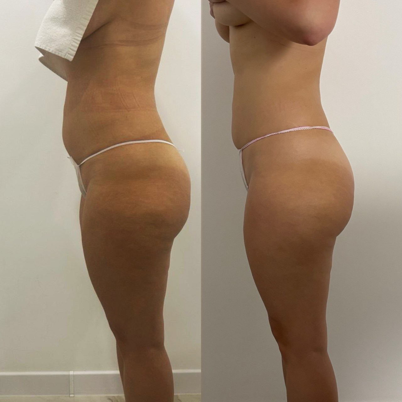 Аппаратный массаж BBEndospheres