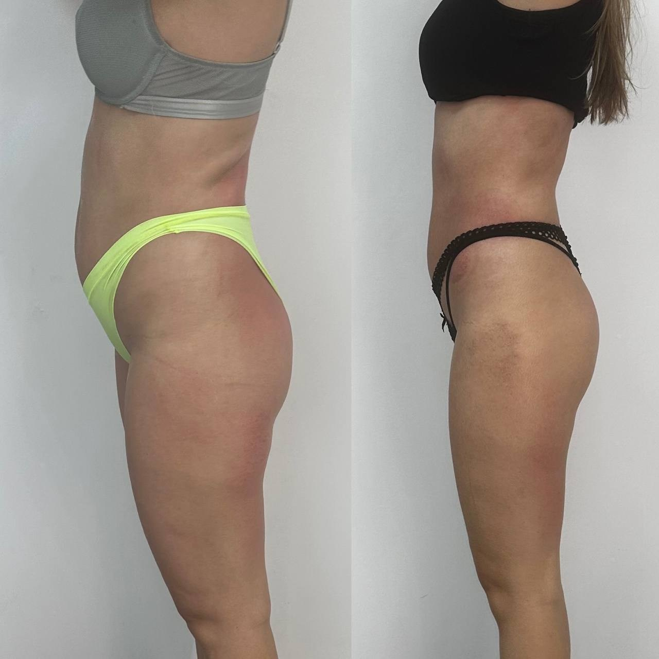 Результаты. Центр Коррекции Тела в городе Чехов