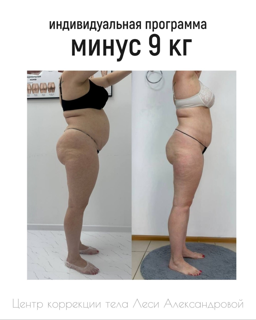 Результаты. Центр Коррекции Тела в городе Чехов