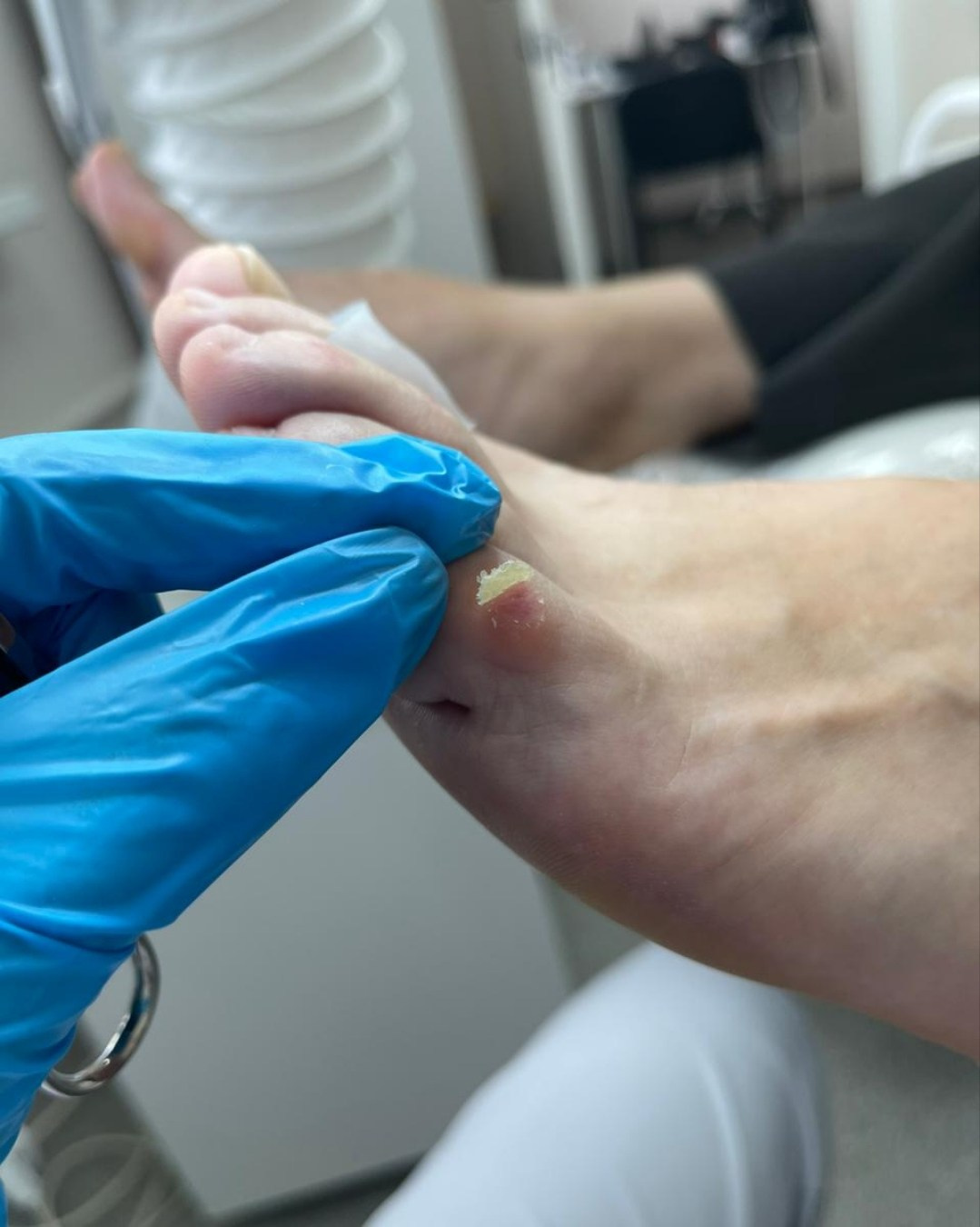 Обработка мозоли. Работа Щёголевой Джулии.