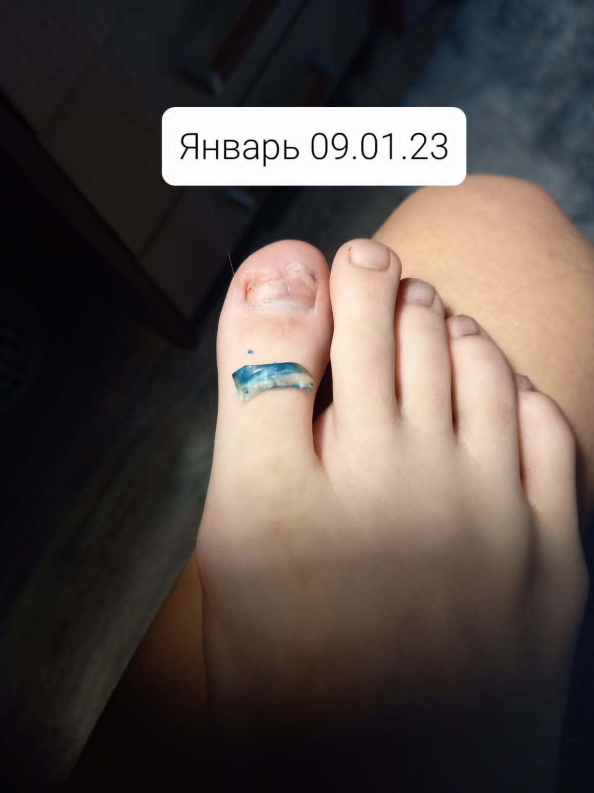 Экзостоз у девочки 13 лет. Подолог г. Хабаровск — центр здоровой стопы «FOOTTIME»