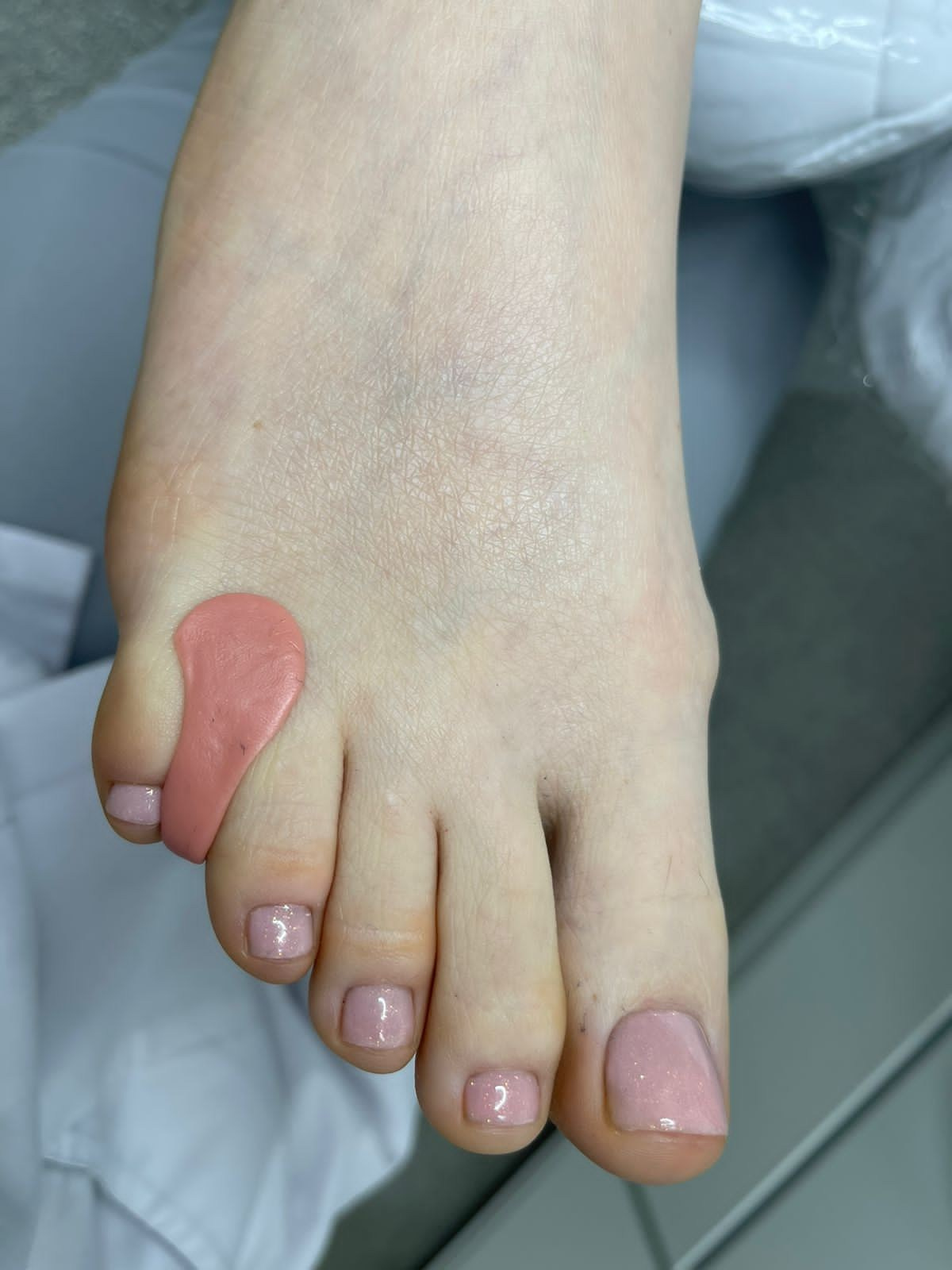 Изготовление индивиуального ортоза. Подолог г. Хабаровск — центр здоровой стопы «FOOTTIME»